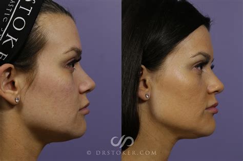 Chiseled Jawline Filler at Jo Diggs blog