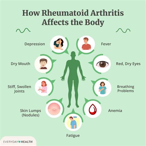 Signs and Symptoms of Rheumatoid Arthritis