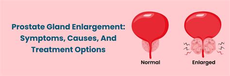 Prostate Enlargement: Symptoms & Treatment