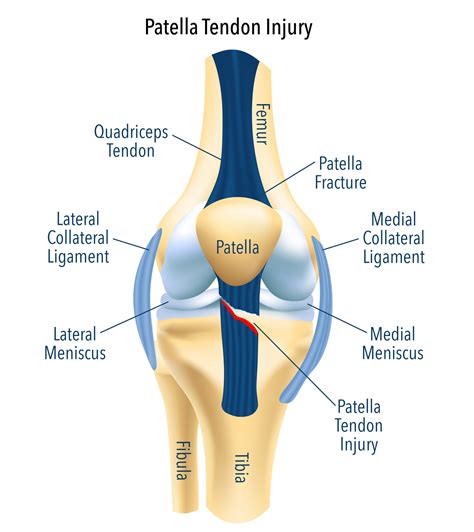 Patella Tendinopathy – The Physiorun Hub