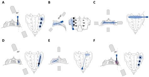Sacroplasty for Sacral Insufficiency Fractures: Narrative Literature Review on Patient Selection ...