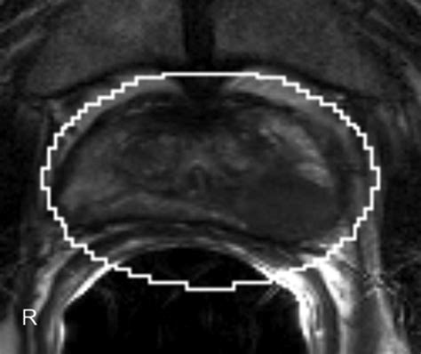 Dynamic Contrast-Enhanced MRI of Prostate Cancer at 3 T: A Study of ...
