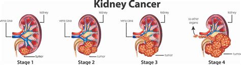 Dr Vivek Venkat Best Surgeon Mumbai for Kidney Cancer Surgery