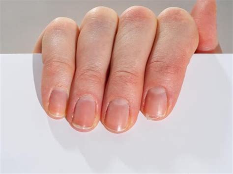 Your nail colour and texture could be warning signs