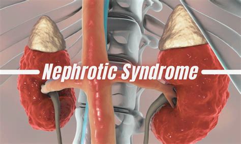 Lenvatinib Linked to Nephrotic Syndrome in VHL Syndrome: Case ...