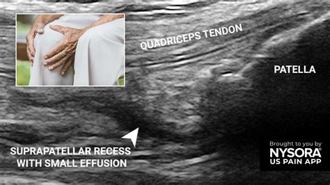 Case study: Ankle joint effusion - Injection - NYSORA