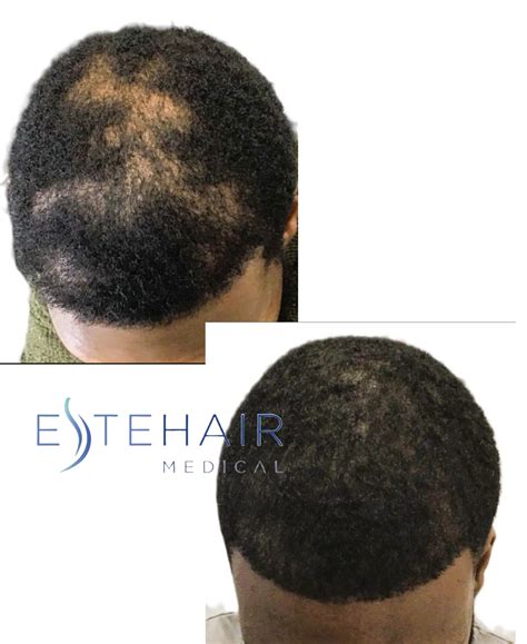 Exosome Hair Loss Treatment - Este Hair Medical