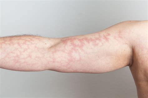 Lupus Mottled Skin & Symptoms (Feb 2025 Update) - The Lupus Encyclopedia