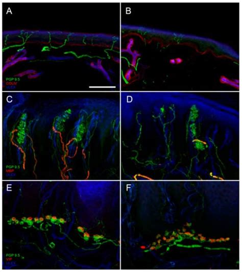 Contribution of Skin Biopsy in Peripheral Neuropathies