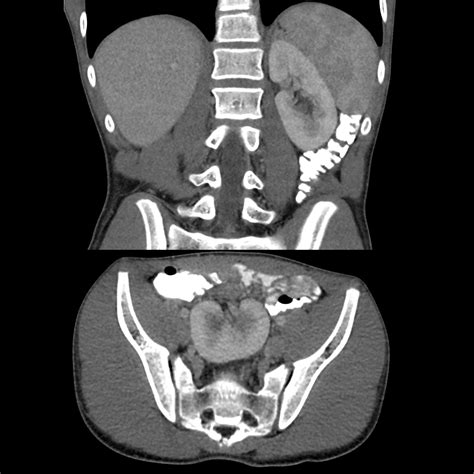 Pediatric Ectopic Kidney | Pediatric Radiology Reference Article | Pediatric Imaging | @pedsimaging