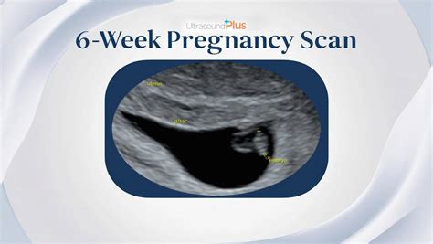 6 Week Pregnancy Scan : What to Expect