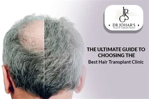 The Ultimate Guide to Choosing the Best Hair Transplant Clinic - Dr ...