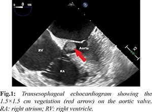 Native Aortic Valve Endocarditis caused by Neisseria elongata in a ...