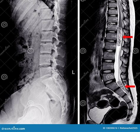 Lumbar Spine Anatomy X Ray _ Normal Spine: X-Ray and CT Anatomy – PKWBV