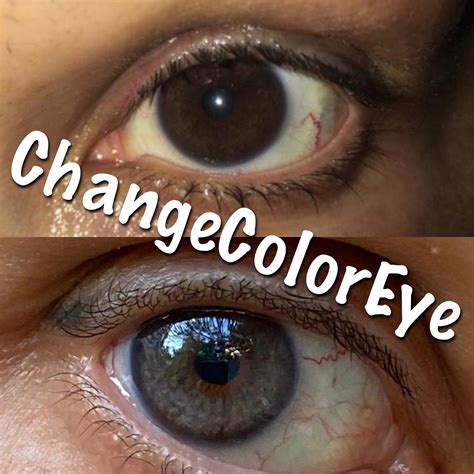Eyes Color Change Hospital at Jorge Damon blog