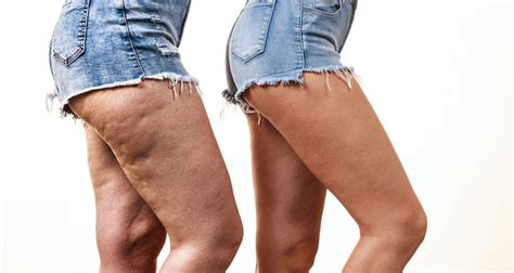 Image result for Cellulite Injection