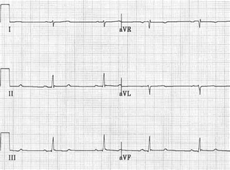 Left Posterior Fascicular Block (LPFB) • LITFL • ECG Library Diagnosis