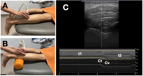 Soleus Muscle Strain