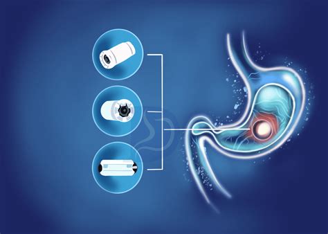 Capsule Endoscopy Procedure | Video Capsule Endoscopy Preparation – HJEGK