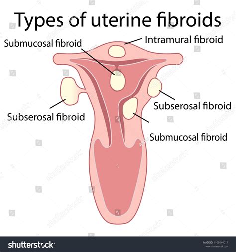 Types Uterine Fibroidsfemale Reproductive Organ Pathology Stock Vector (Royalty Free) 1106844017
