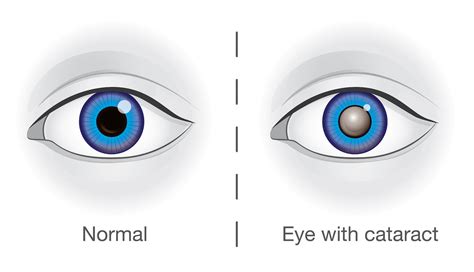 Cataract Surgery Northampton | Cataract Surgeons