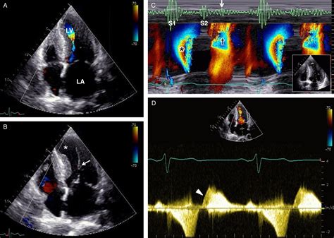 Diastolic murmur in mid-ventricular obstructive hypertrophic ...
