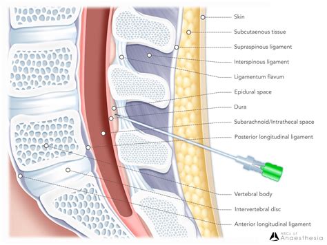 New consensus statement on Postdural Puncture Headache: renewed ...