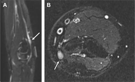 MRI Neurography of Peripheral Nerve Injury - Advances in Clinical Radiology