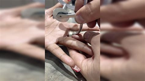 Woman gets three rings removed from her finger 15 years after they got ...