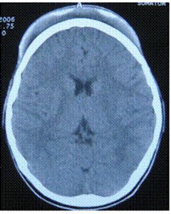 Delayed extensive subgaleal hematoma following minor head injury ...