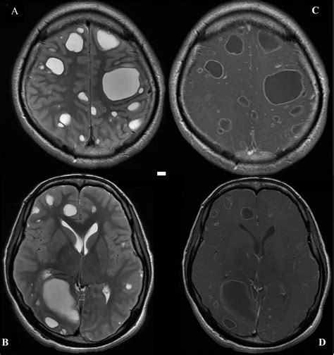 Multiple Intracranial Cystic Brain Lesions: A Diagnostic Dilemma - Pediatric Neurology
