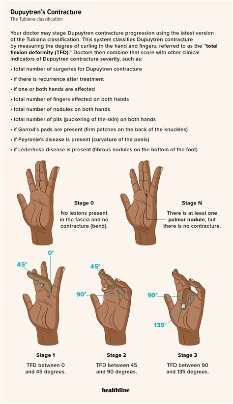 What Dupuytren's Contracture Looks Like