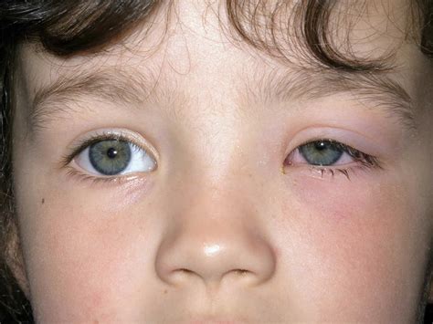 Eye Cellulitis Pictures
