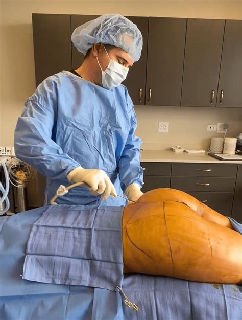 Nonsurgical vs. Surgical BBL in Chicago: Safe Brazilian Butt Lift Options at BodyLuxe - Awake ...