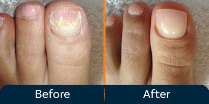 Full Toenail Extraction 的图像结果