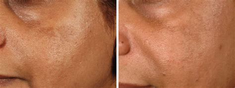 Laser und EBD – was gibt es Neues? - Dermatologie - Universimed ...