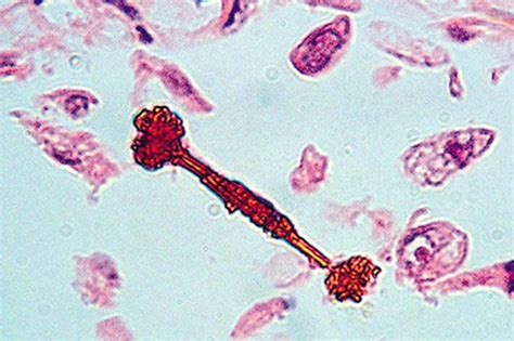 Asbestosis - Asbestosis - MSD Manual Professional Edition