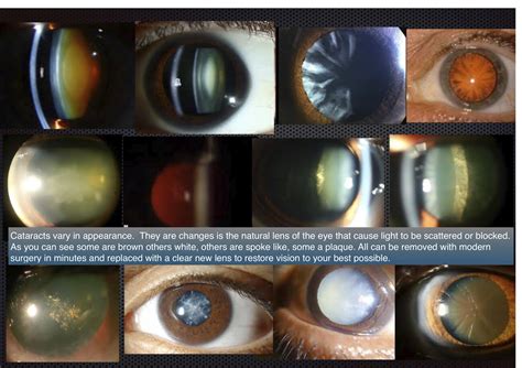 Cataracts Types