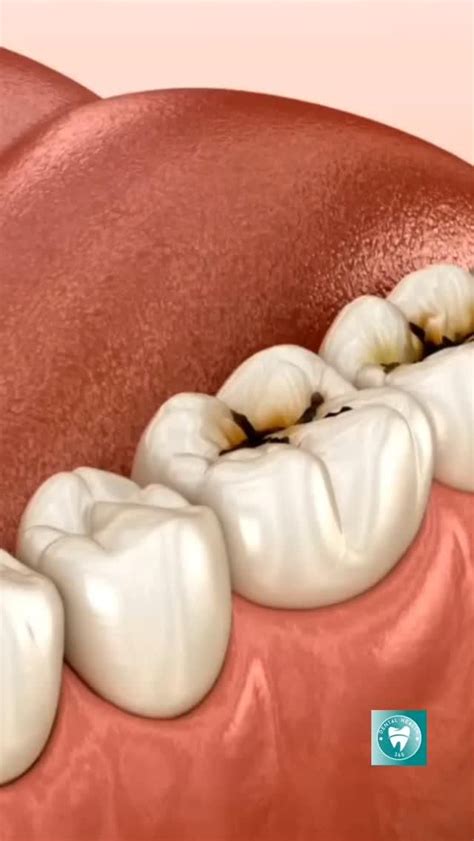 Image result for Getting Tooth Removed