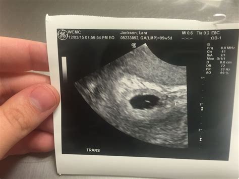 5 Weeks Ultrasound