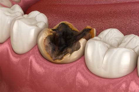 Toothache 的图像结果