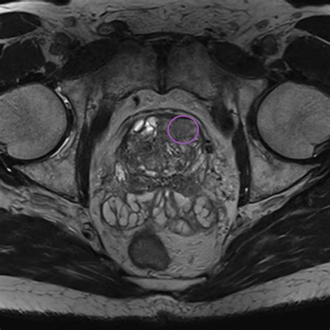 Review of Clinically Significant Cancer in Lesions Labeled PI-RADS 3 on MRI Using PI- RADS ...