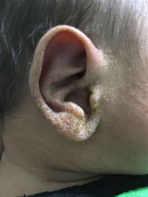 Crusty Ears