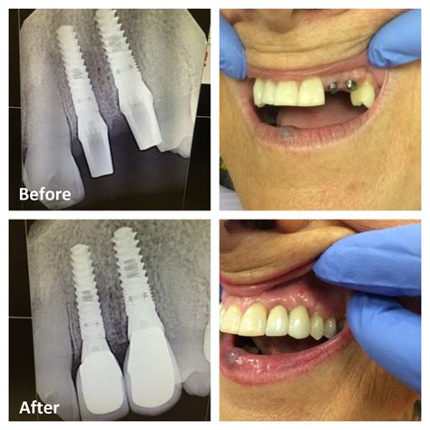 Dental Implants Front Teeth Before And After at Jody Featherston blog