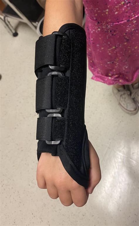 State of the Art Pediatrics: Buckle Fractures in Children - Children's ...