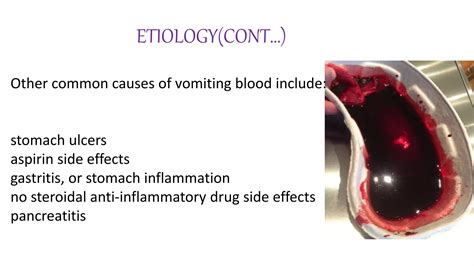 Hematemesis- vomiting of blood , a brief study | PPTX