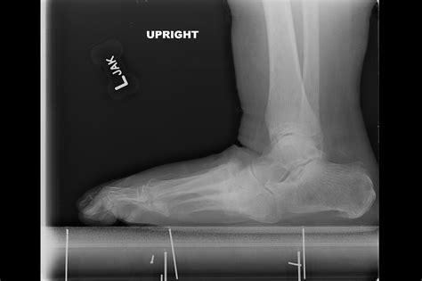 Ortho Dx: Severe Charcot Arthropathy - Clinical Advisor
