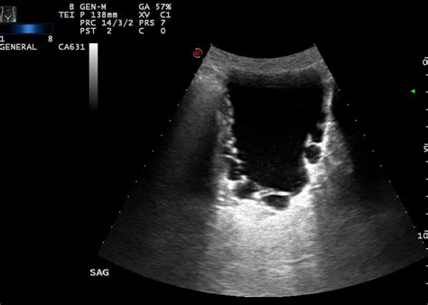 Bladder Trabeculation