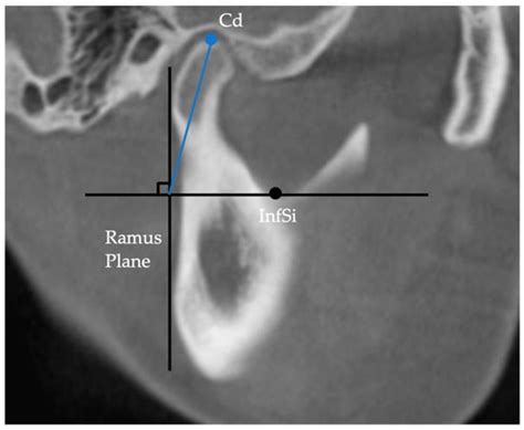 Comparison of Mandibular Volume and Linear Measurements in Patients ...