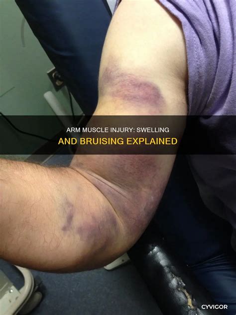Arm Muscle Injury: Swelling And Bruising Explained | CyVigor